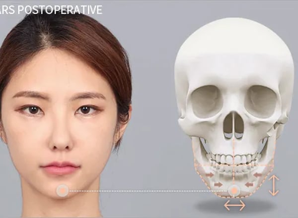 3개 안면윤곽술